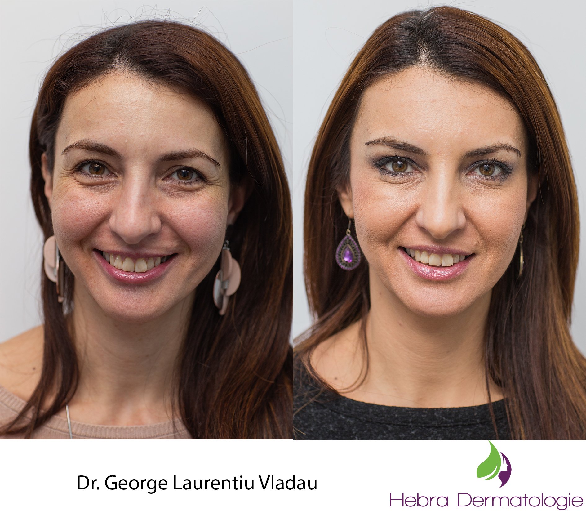 Rejuvenare faciala: proceduri, rezultate, sfaturi
