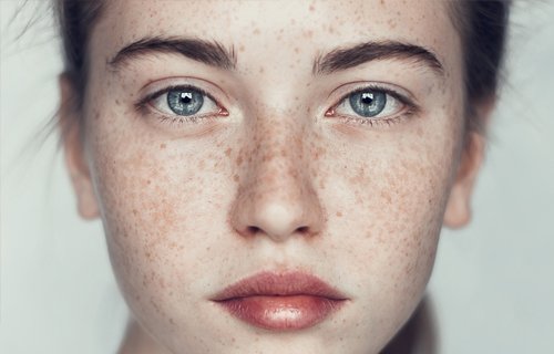 4 cauze ale hiperpigmentarii pielii