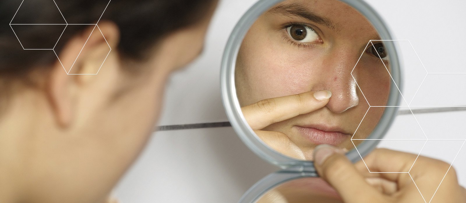 rim friction Unlike Legatura dintre dereglarile hormonale si aparitia acneei | Hebra  Dermatologie