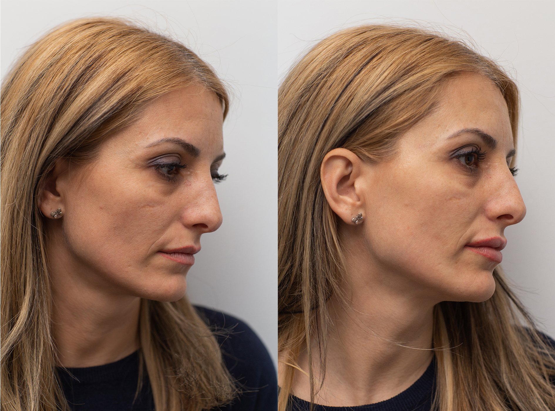 injectarea cu acid hialuronic in sarcina